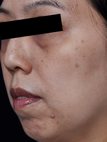 ピコウェイによるシミ取りの症例 | ZX-CLINIC【公式】｜大阪梅田・北